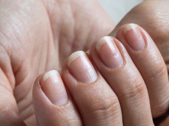 Understanding Onycholysis Common Causes and Symptoms What s Inside Light Elegance